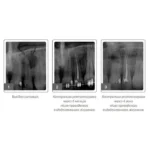 Jen-MetroHeCor (Джен-МетроГеКор), шпр.2мл - Антисептичний гель (хлоргексидину діацетат, метронідазолу бензоат, гідрокортизону ацетат) (Джендентал-Україна)