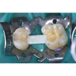 Jen-Fiber Bulk (Джен-Файбер Балк), 6шт/пак форма: № 3; розм.= 1.8х30 мм - Скловолоконні балки (скловолокно) (Джендентал-Україна)