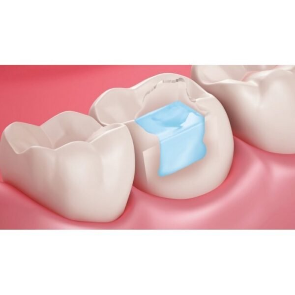 Jen-Radiance Molar FW, шпр.6г - Балк-філл композит, текучий (Джендентал-Україна)