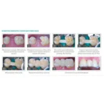 Jen-Fiber Bulk (Джен-Файбер Балк), 6шт/пак форма: № 3; розм.= 1.8х30 мм - Скловолоконні балки (скловолокно) (Джендентал-Україна)