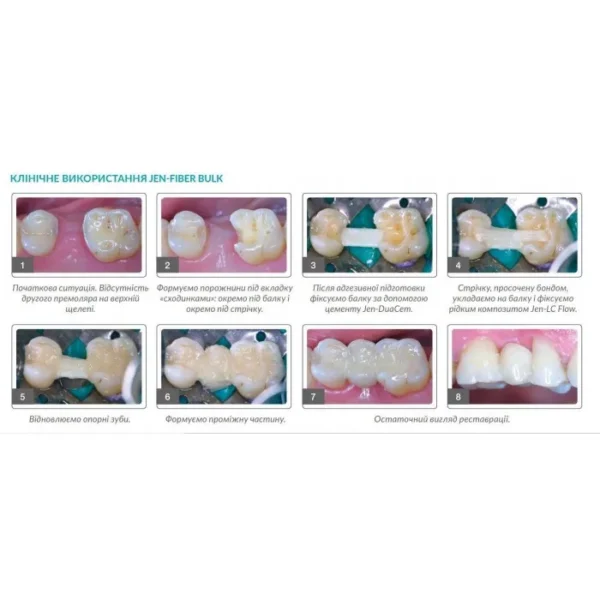 Jen-Fiber Bulk (Джен-Файбер Балк), 6шт/пак форма: № 3; розм.= 1.8х30 мм - Скловолоконні балки (скловолокно) (Джендентал-Україна)