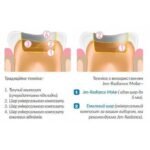 Jen-Radiance Molar FW, шпр.6г - Балк-філл композит, текучий (Джендентал-Україна)