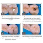 Jen-Radiance FCP (Джен-Радіанс FCP), шпр.3г - Барвник композитний (Джендентал-Україна)