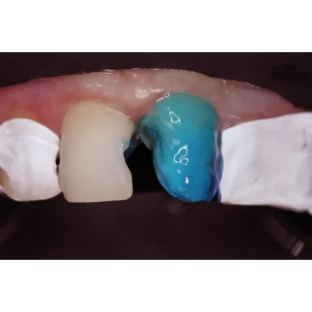 Травильний гель (37% ортофосфорної кислоти з антисептиком) phospho jen as (Фосфо Джен as) (Джендентал Україна)