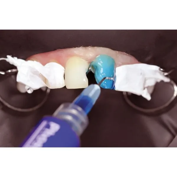 Травильний гель (37% ортофосфорної кислоти з антисептиком) Phospho-Jen AS (Фосфо-Джен AS) (Джендентал-Україна)