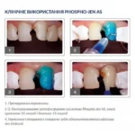 Травильний гель (37% ортофосфорної кислоти з антисептиком) Phospho-Jen AS (Фосфо-Джен AS) (Джендентал-Україна)
